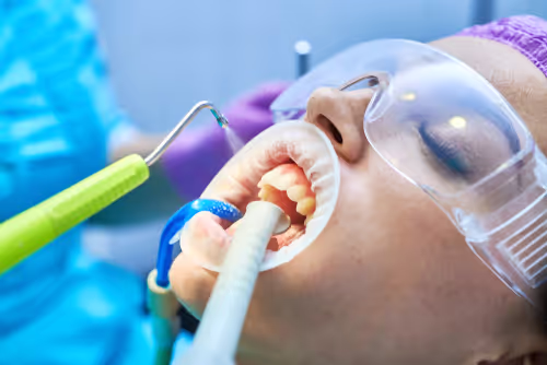 Patient wearing protective goggles with mouth open during a dental air abrasion procedure.