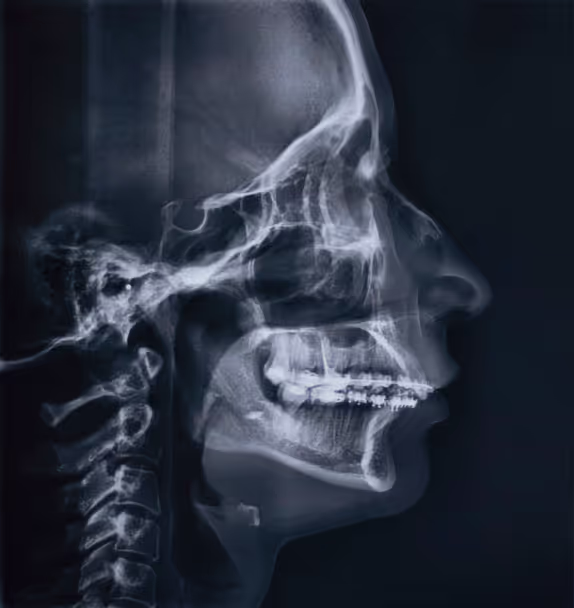 Lateral cephalometric X-ray showing the side profile of a human skull with visible teeth and cervical spine.